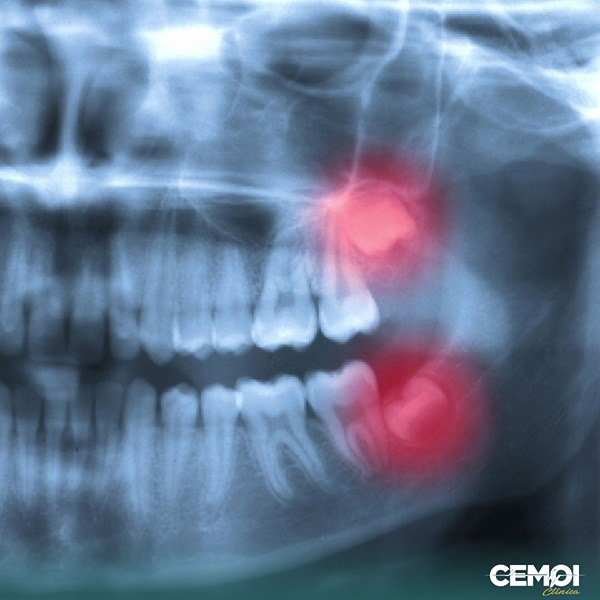 Cirurgia bucomaxilofacial: o que é? É a área da Odontologia que objetiva diagnosticar, acompanhar e tratar cirurgicamente os traumatismos e anomalias congênitas e adquiridas do aparelho mastigatório e seus anexos, além das estruturas crânio-faciais associadas. CEMOI clínica odontológica em Brasília